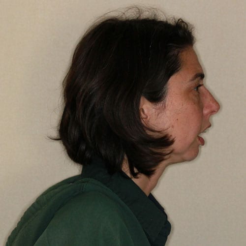 Before Face Profile