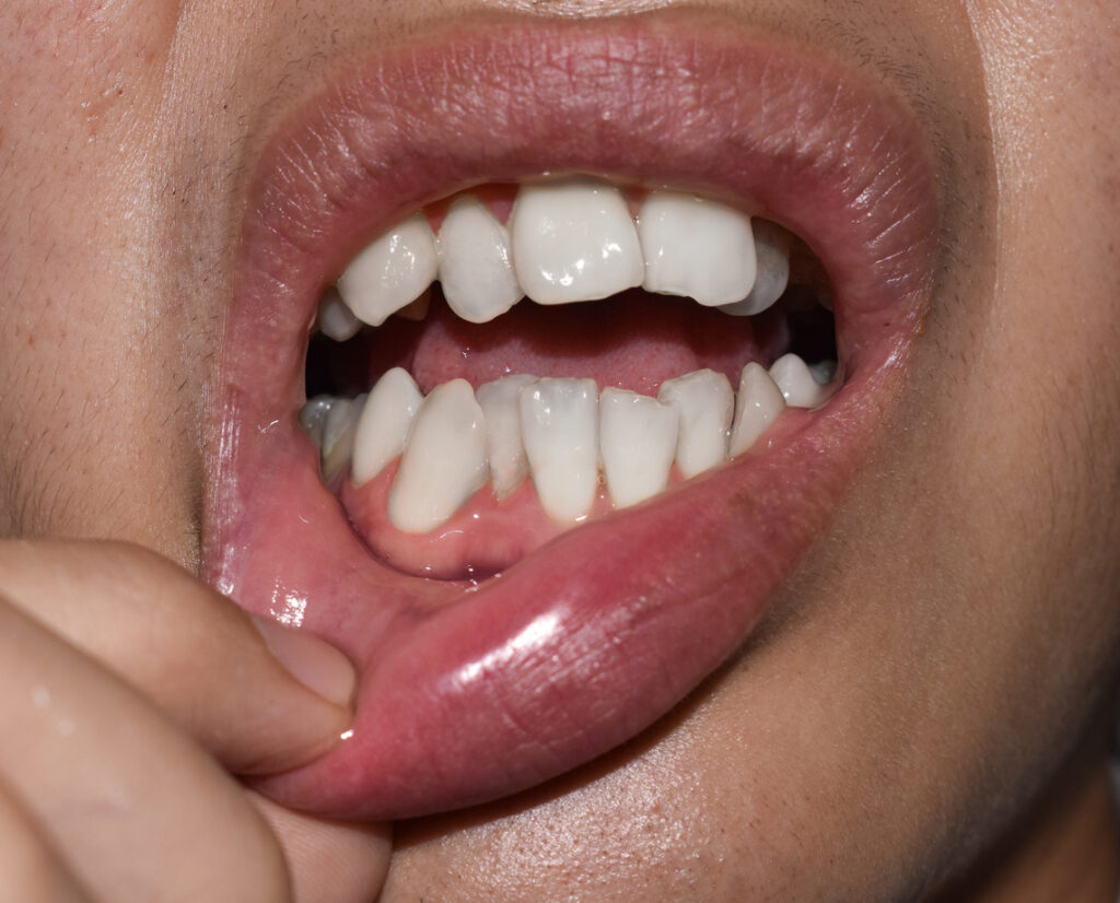 fix crowded teeth