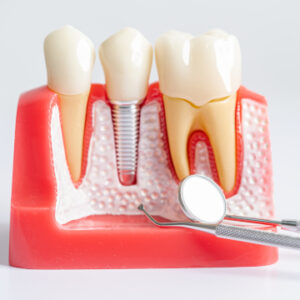 dental implant guide