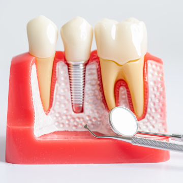 dental implant guide