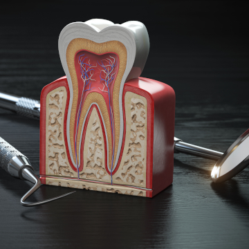 root canal
